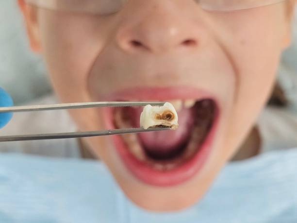 Best Emergency Tooth Extraction in Dolgeville, NY
