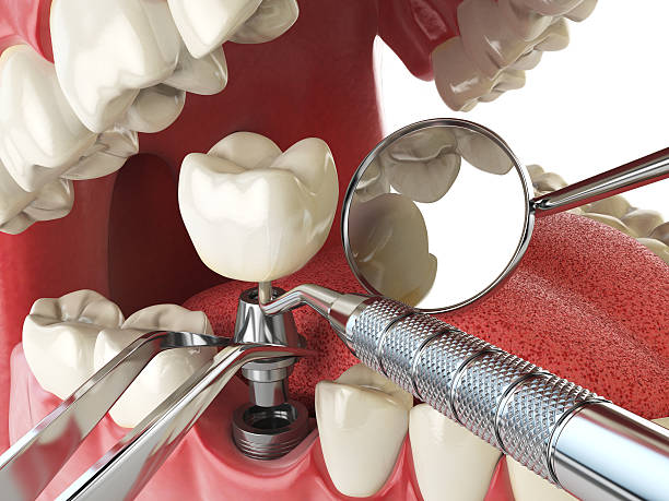 Best Emergency Root Canal Treatment in Dolgeville, NY