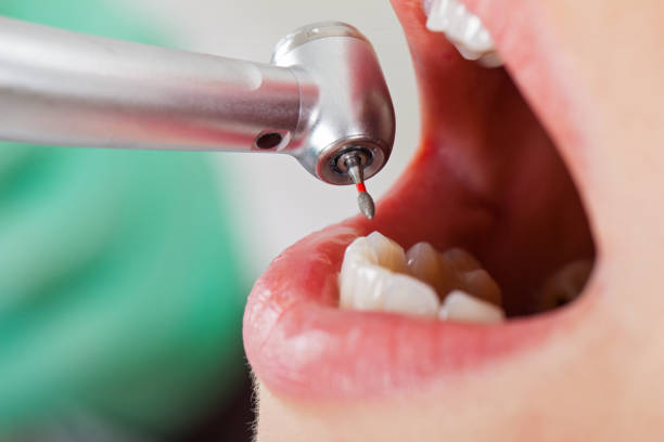 Best Emergency Dental Care for Broken or Chipped Teeth in Dolgeville, NY